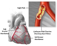 Arter Hastalığı Belirtileri ve Tedavisi