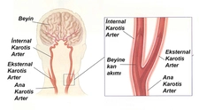 Karotis Arter Belirtileri ve Tedavisi