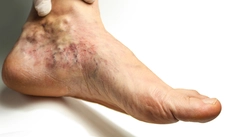 Periferik Arter Hastalığı Belirtileri ve Tedavisi